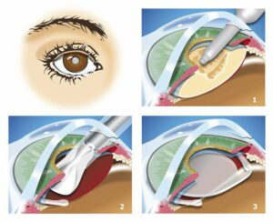 lens-replacement-surgery